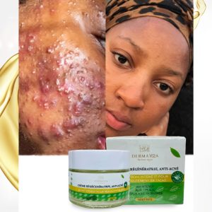 🌿 CRÈME RÉGÉNÉRATRICE Et RÉCUPÉRATRICE ANTI-ACNÉ
DermaH24