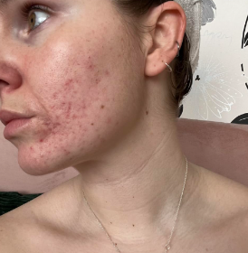 🔥DUO✨ DITES ADIEU À L’ACNÉ & AUX TACHES ✨ AVEC L'HUILE D'ACIDE KOJIQUE, TAMPONS NETTOYANTS À L'ACIDE KOJIQUE ET AU CURCUMA ET SAVON AU GLUTATHION & CURCUMA photo review