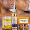 🔥DUO✨ DITES ADIEU À L’ACNÉ & AUX TACHES ✨ AVEC L'HUILE D'ACIDE KOJIQUE, COTON ET SAVON AU LEMON & CURCUMA