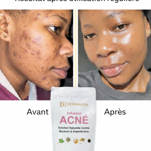 THÉ - INFUSION ACNÉ – SOLUTION NATURELLE CONTRE BOUTONS & IMPERFECTIONS